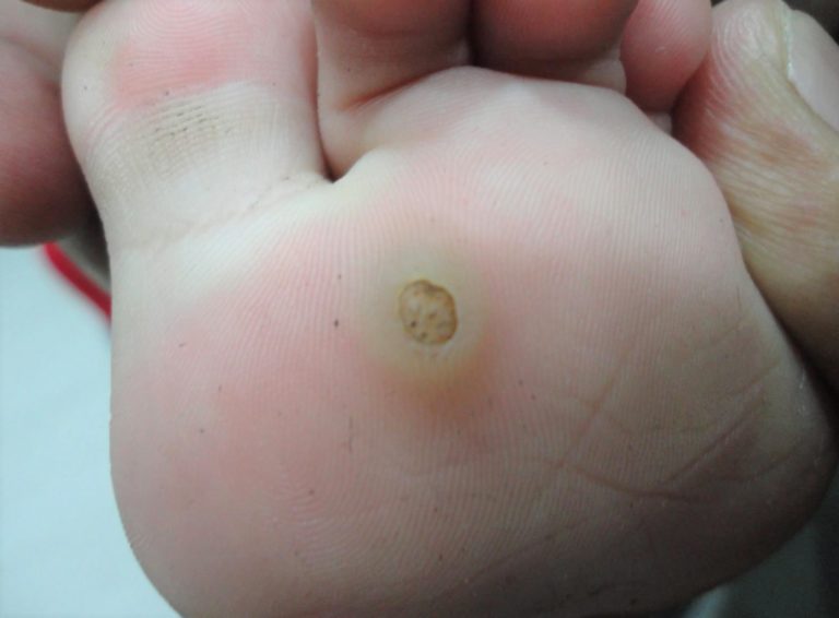 Warts - Plantar Wart - Wart On Finger, Hands, Face - Wart Treatment