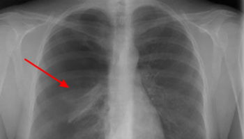 pneumothorax