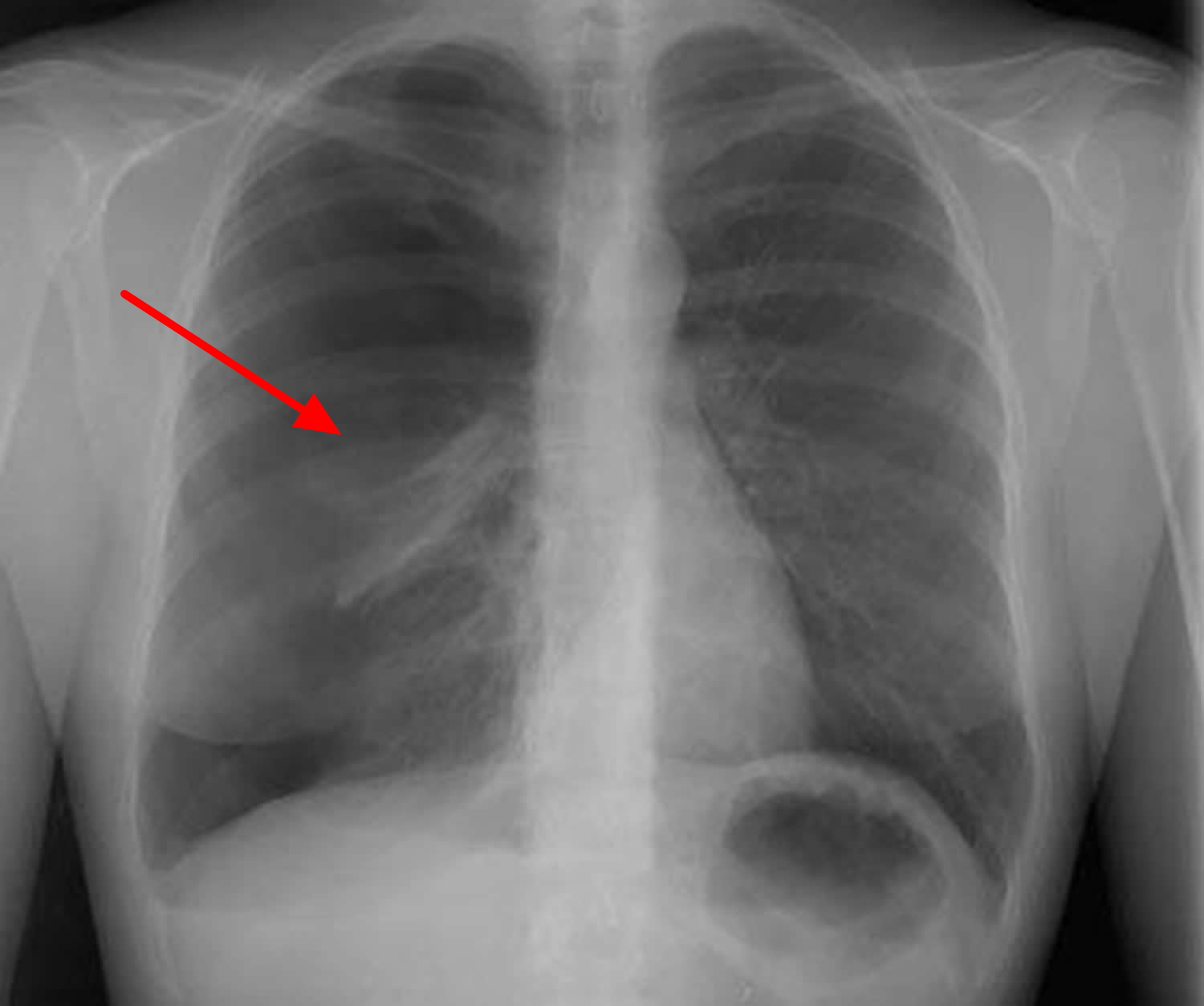 Spontaneous Pneumothorax Tracheal Deviation