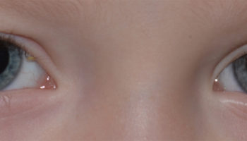 retinoblastoma