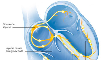 sick sinus syndrome