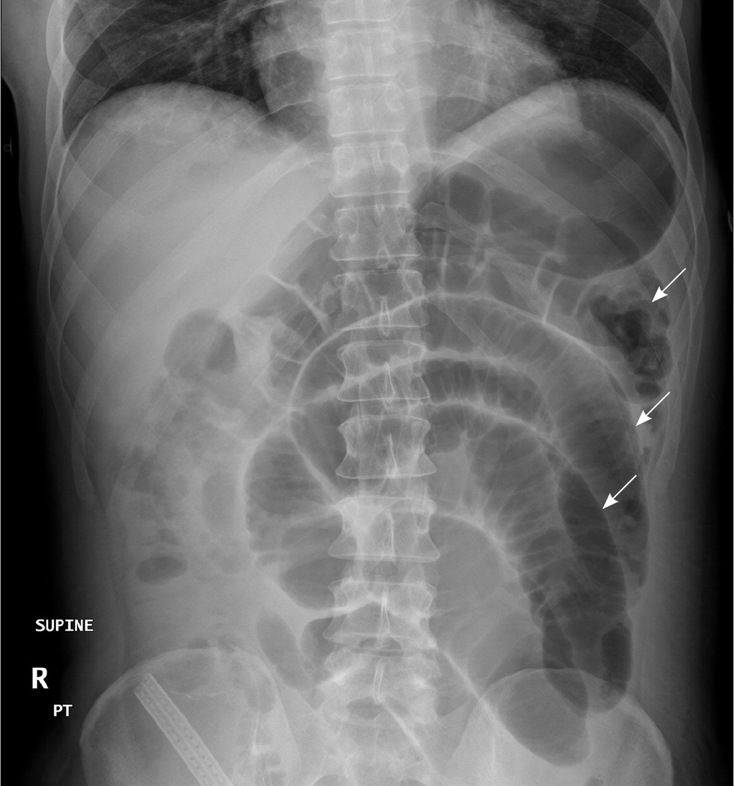 Raio X Obstrução Intestinal - RETOEDU