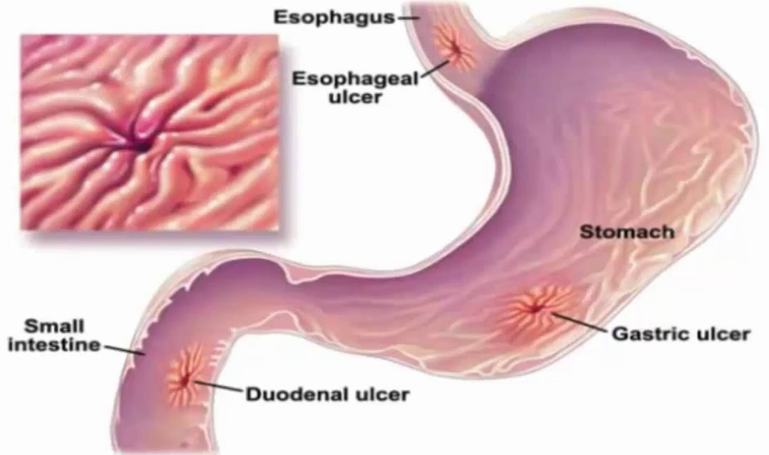 What Are The Causes For Gastric Ulcers