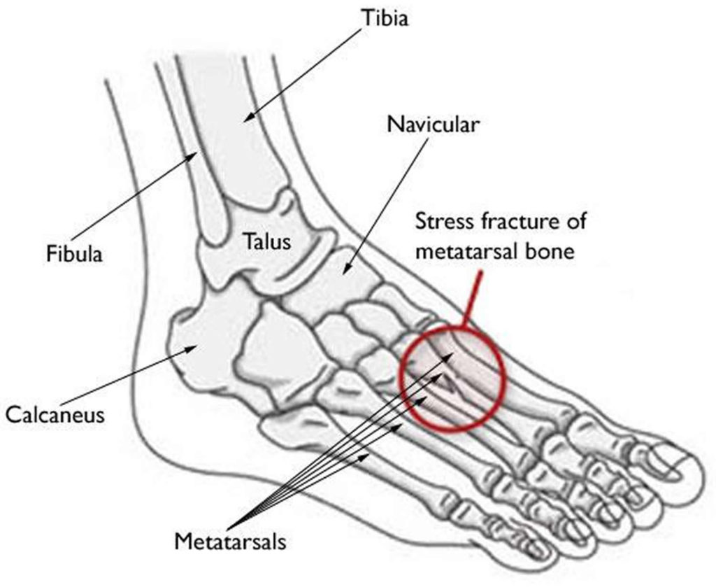 Broken Ankle - Fractured Ankle, Broken Foot, Stress Fracture Ankle