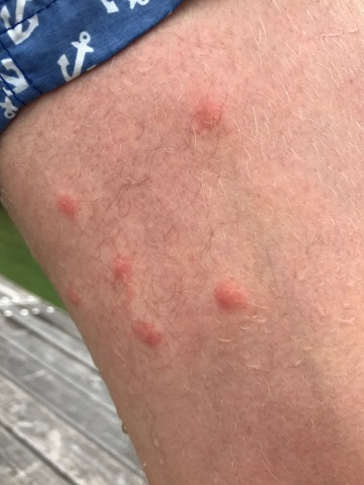 swimmers itch