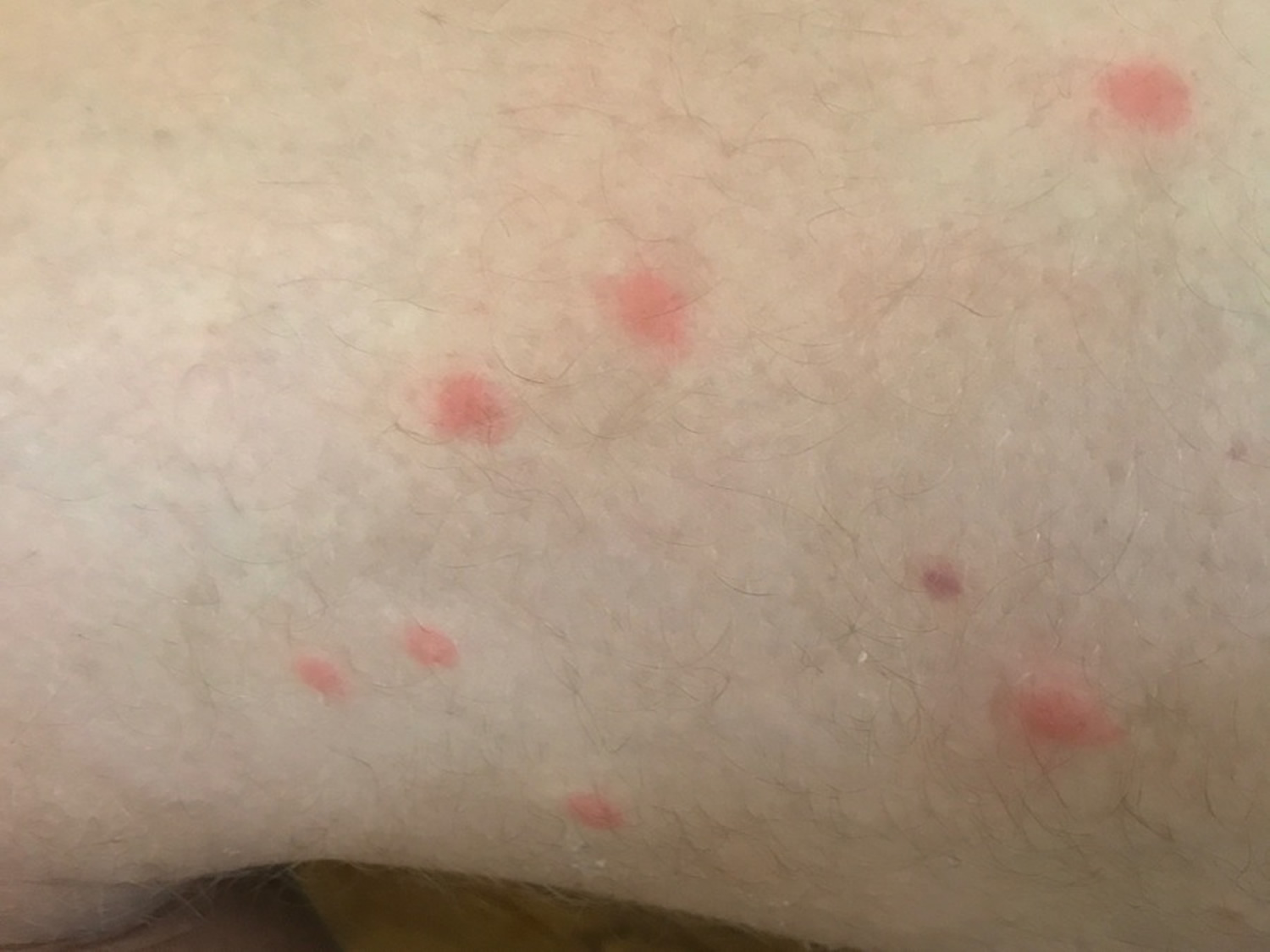 Itchy Rash After Swimming In Sea