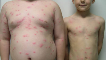 swimmers_itch