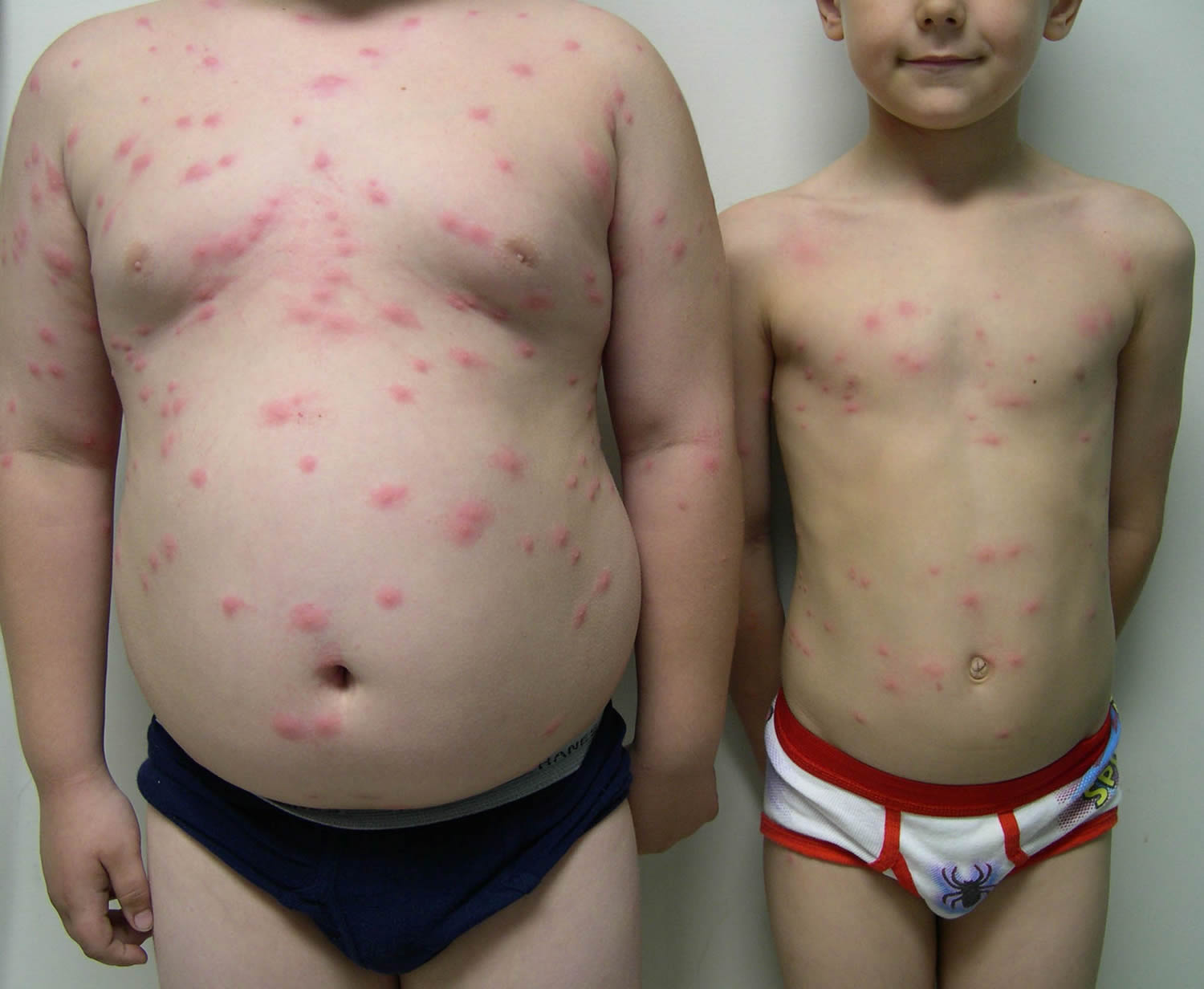 Swimmers Itch & Cercarial Dermatitis - Causes, Prevention, Treatment