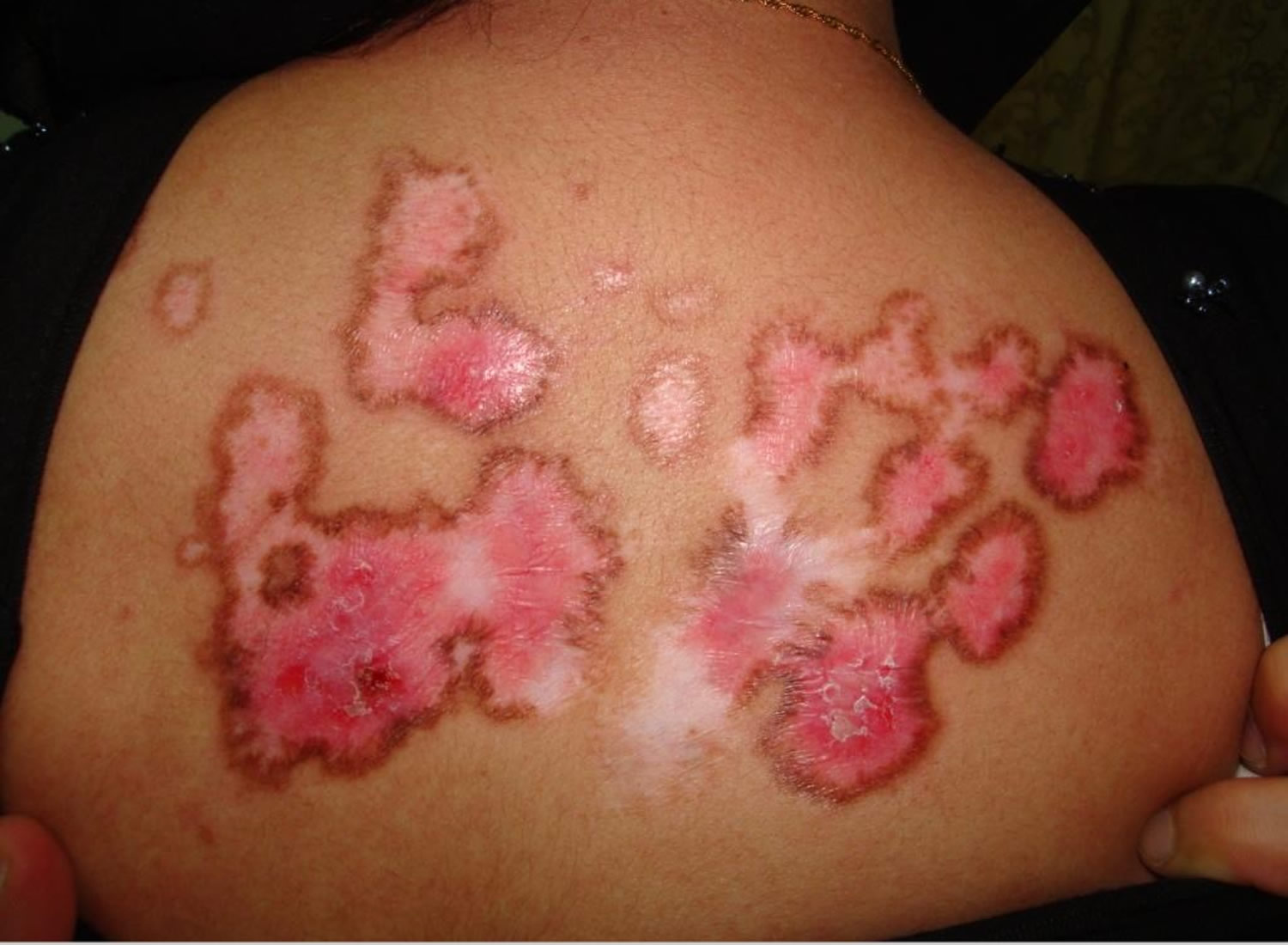systemic lupus erythematosus rash