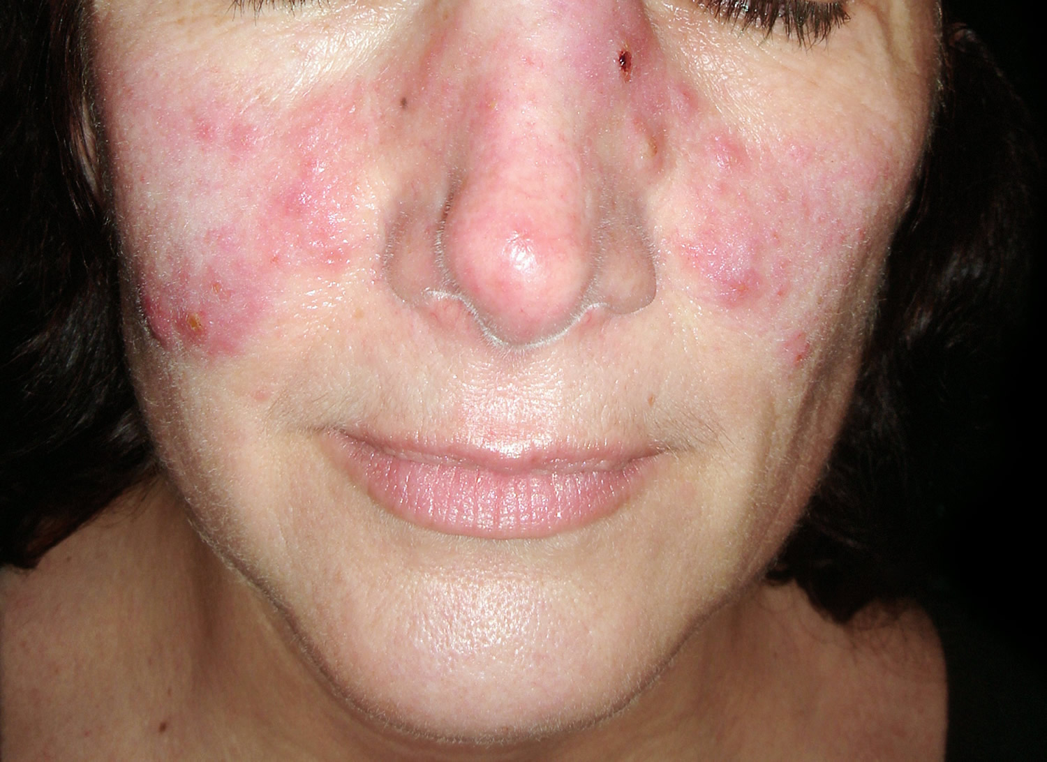 systemic lupus erythematosus malar rash
