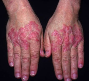 Lupus - Systemic Lupus Erythematosus (SLE) - Causes, Sign & Symptoms