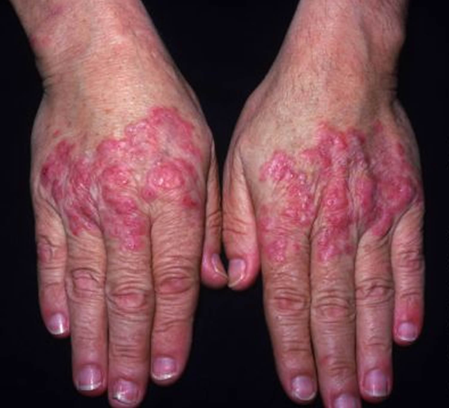 Systemic Lupus Erythematosus And Its Effects On