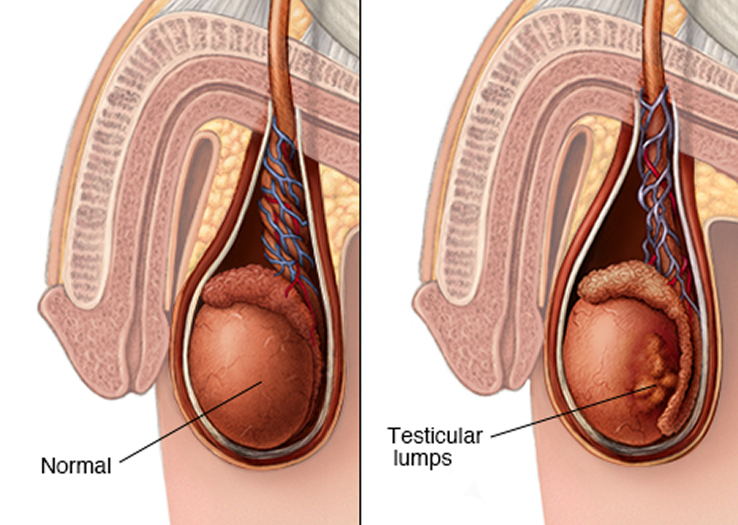 Testicular Cancer Symptoms Causes Lump Survival Rate