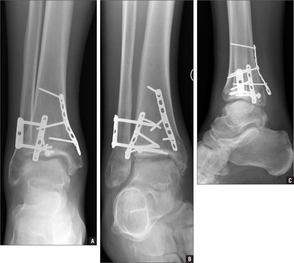 Broken Ankle - Fractured Ankle, Broken Foot, Stress Fracture Ankle