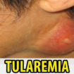 tularemia