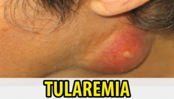 tularemia