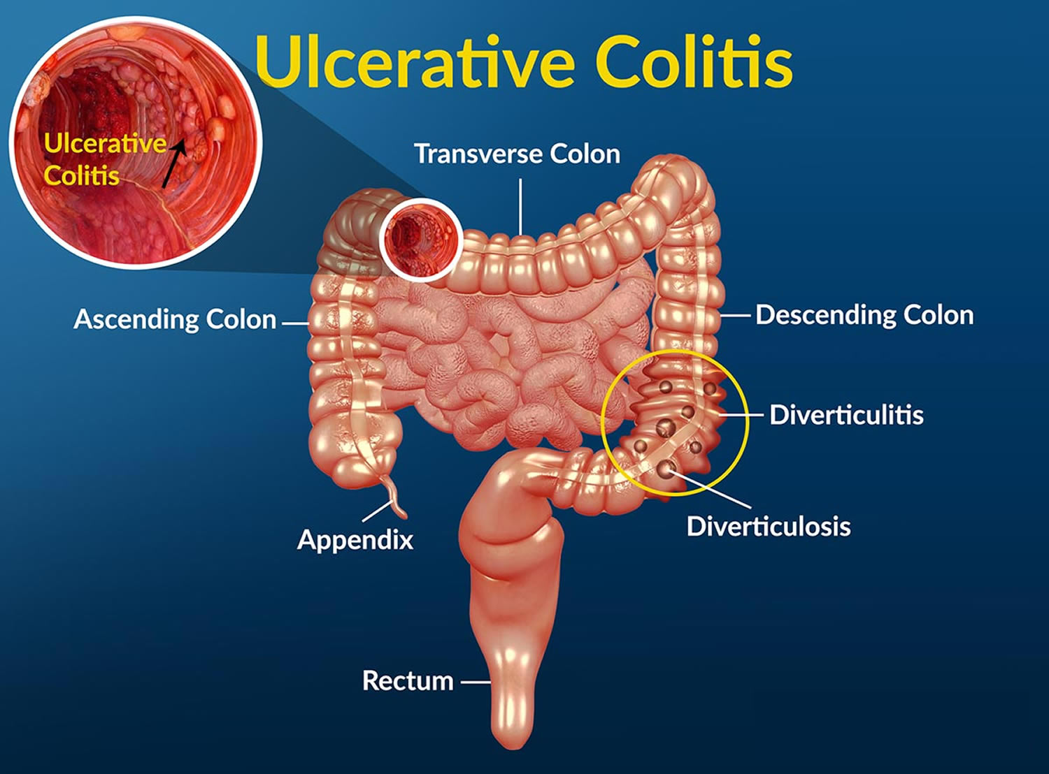 Ulcerative Colitis - Causes, Symptoms, Diet, Surgery ... diagram of colitis 