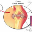 uric acid