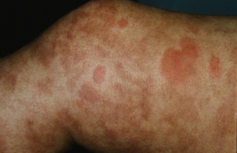 Urticarial Vasculitis Types Causes Symptoms Treatment