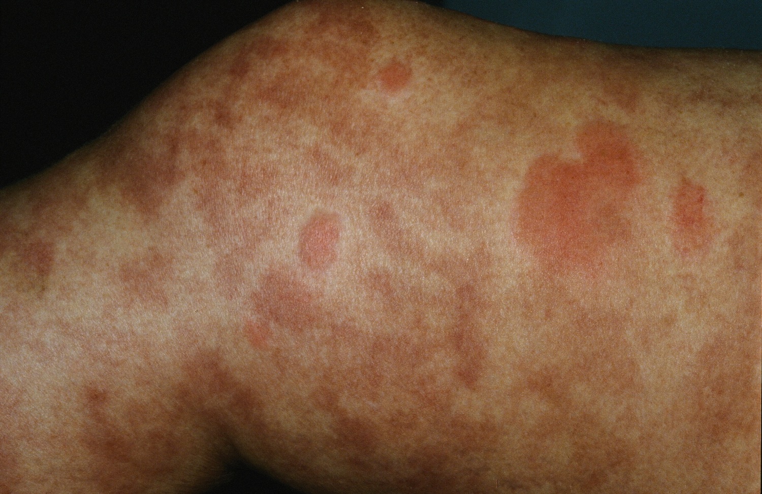 Urticarial Vasculitis Rash