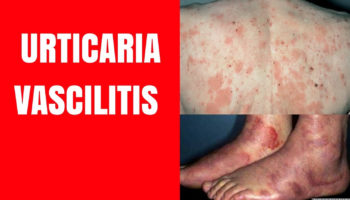 urticarial vasculitis