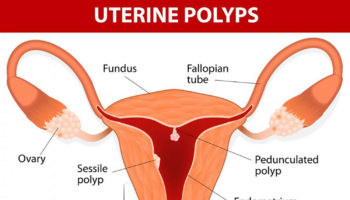 uterine polyps