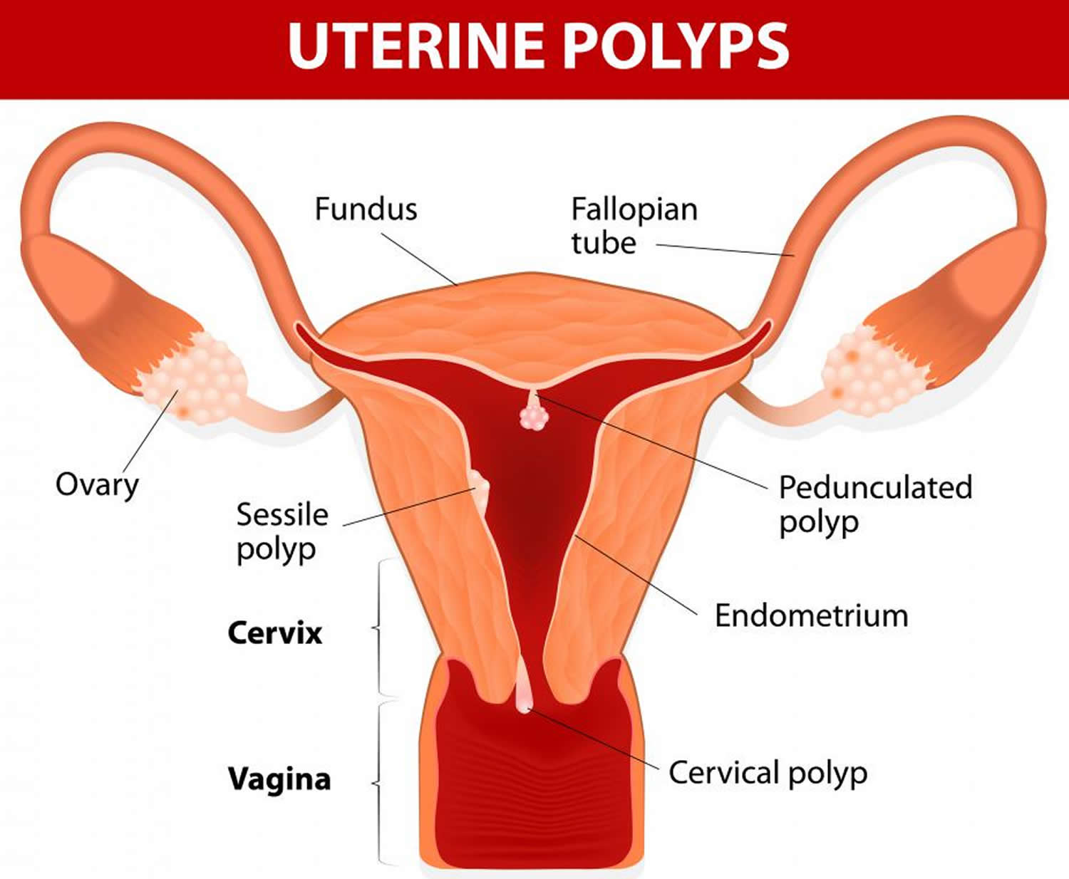 Uterine Polyp Biopsy Results Time