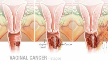 vaginal cancer