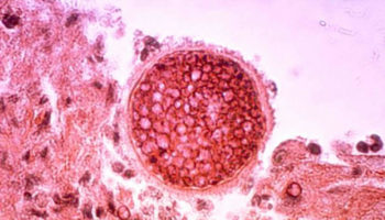 valley fever