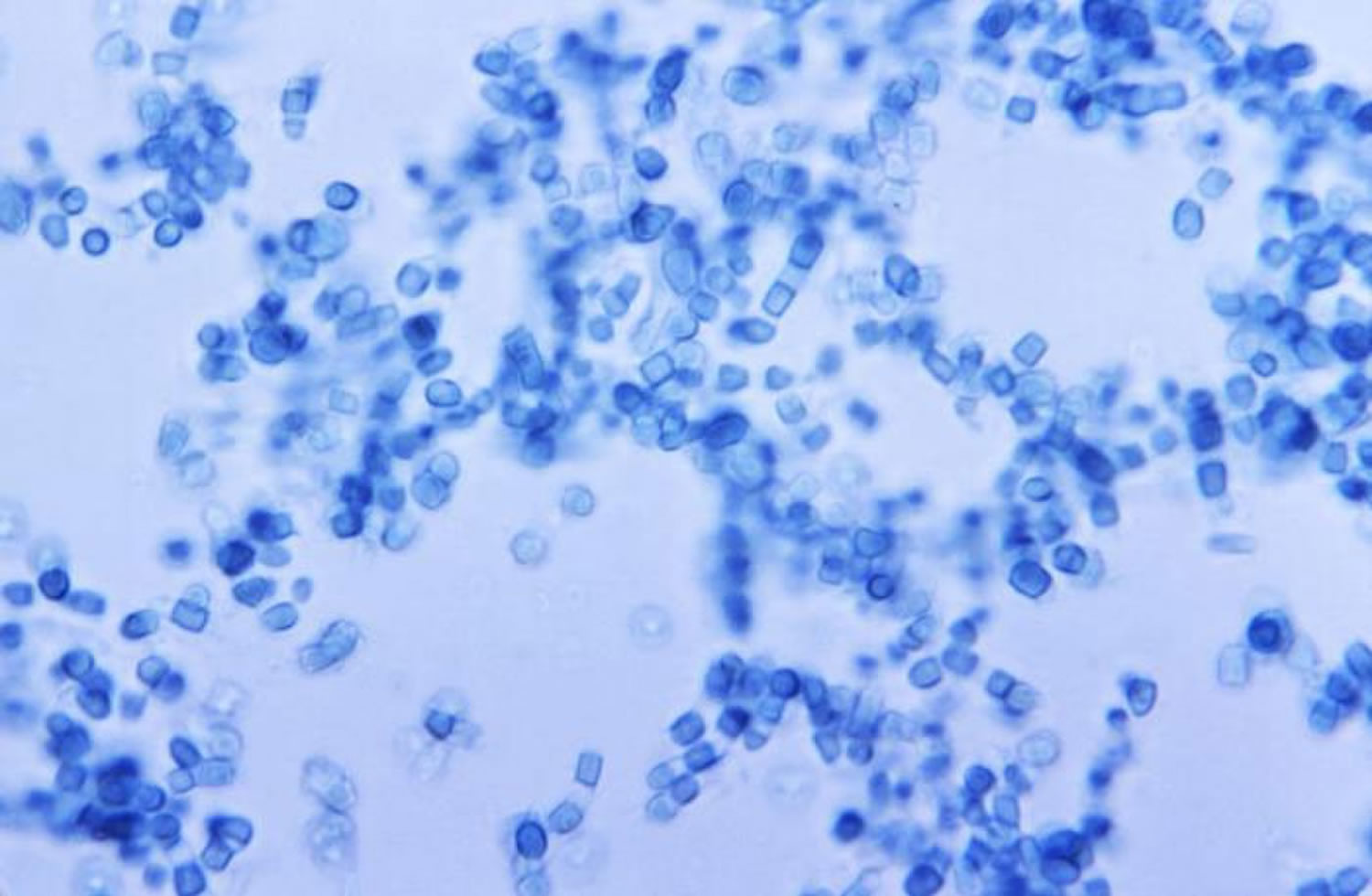 Valley Fever - Coccidioidomycosis - Causes, Symptoms, Treatment