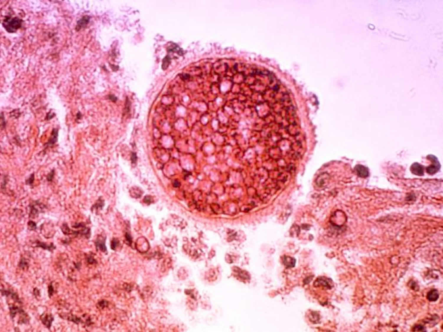 Valley Fever Coccidioidomycosis Causes Symptoms Treatment