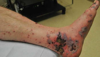 vasculitis