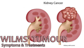 wilms tumor