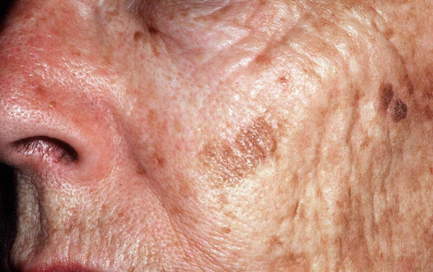 Age Spots - Causes, How To Get Rid, Cream &amp; Treatment
