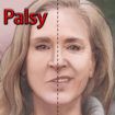 Bell’s palsy