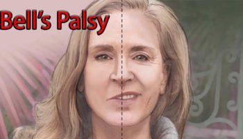 Bell’s palsy