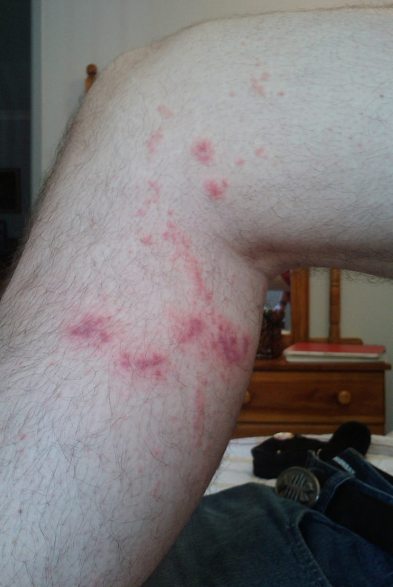 Jellyfish Sting Symptoms, How To Treat A Jellyfish Sting