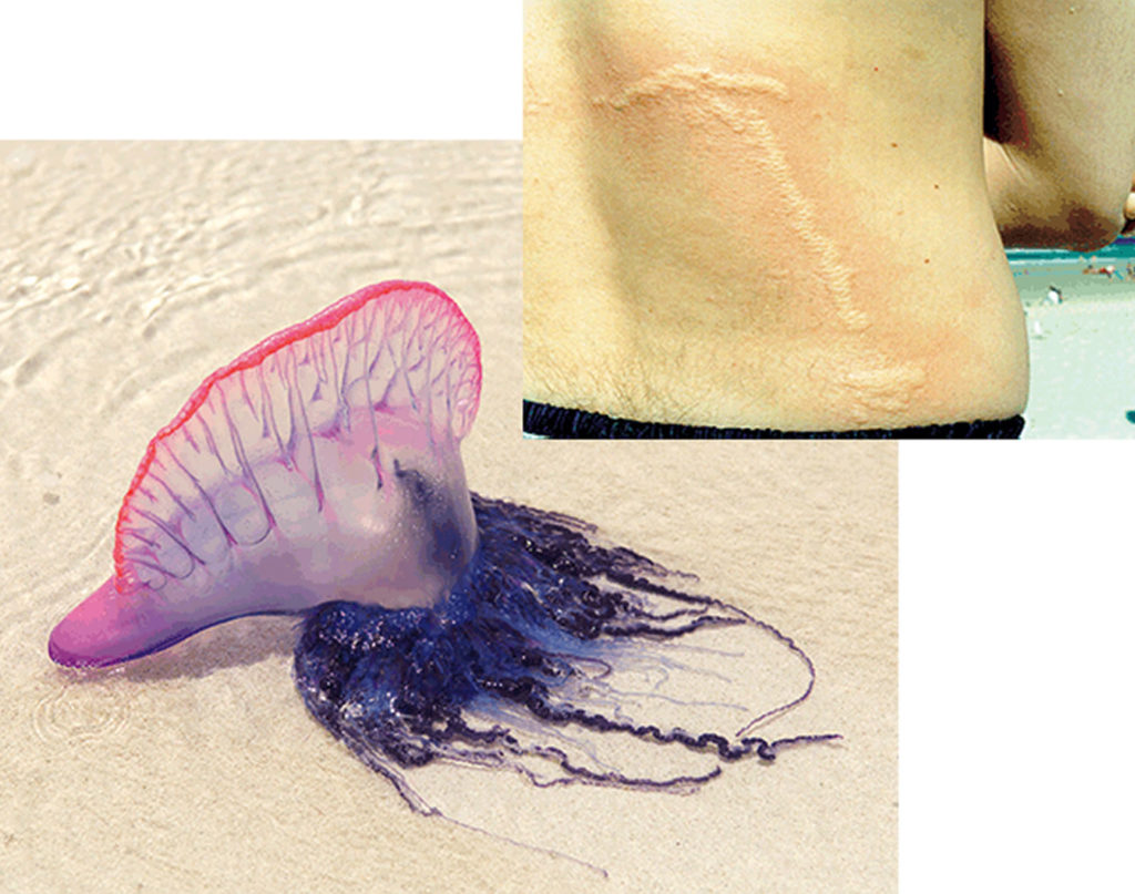 Jellyfish Sting - Symptoms, How To Treat A Jellyfish Sting