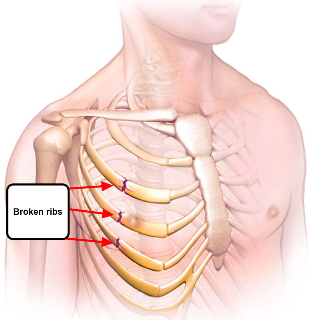 long term effects of broken ribs