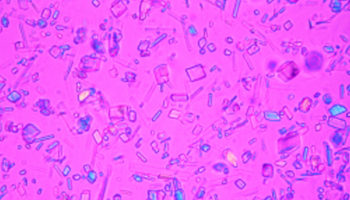 Calcium pyrophosphate crystals