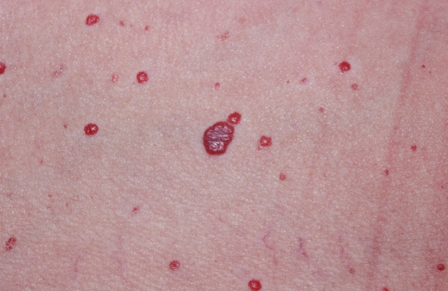 Capillary Hemangiomas