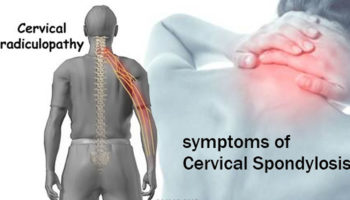 Cervical Spondylosis