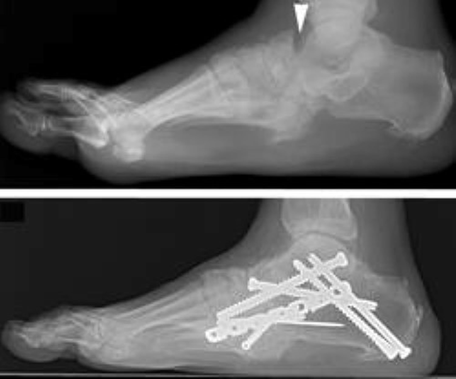 Charcot Foot surgery