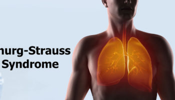 Churg-Strauss-Syndrome