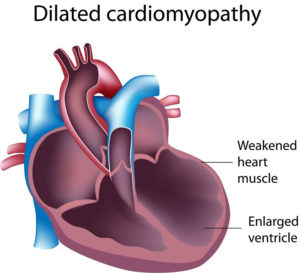 Dilated Cardiomyopathy - Causes, Signs, Symptoms, Treatment