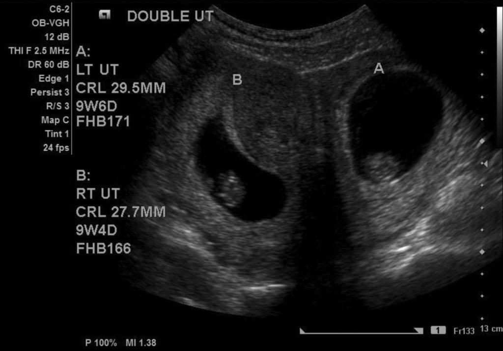 Double Uterus - Causes, Symptoms, Complications