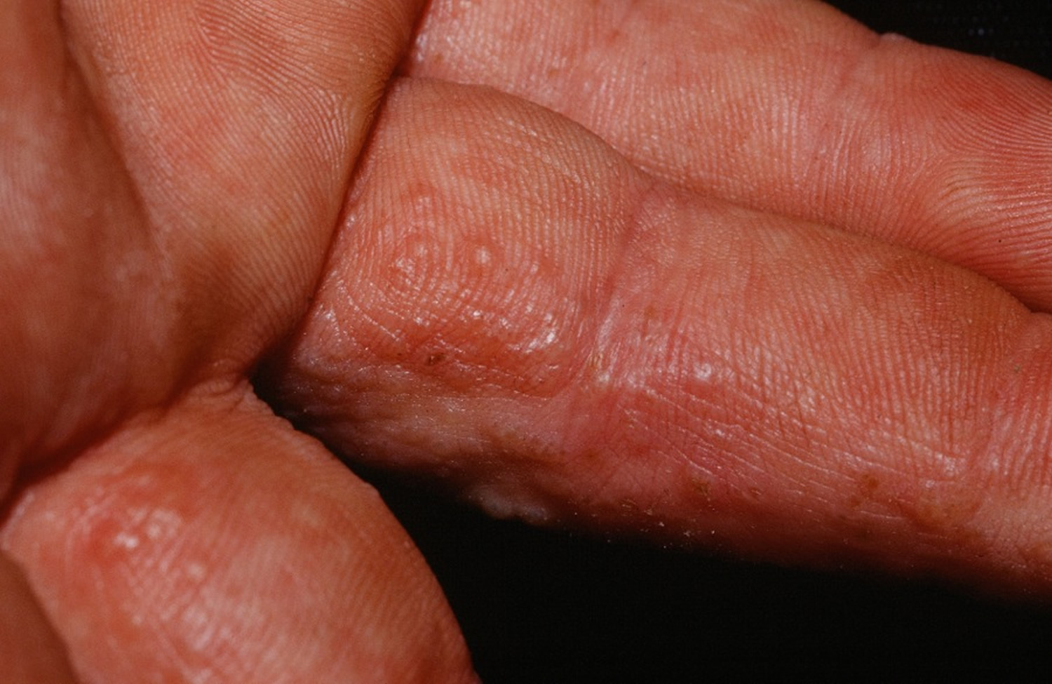 Dyshidrosis fingers