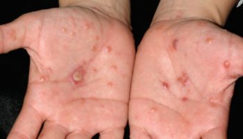 Dyshidrosis hands