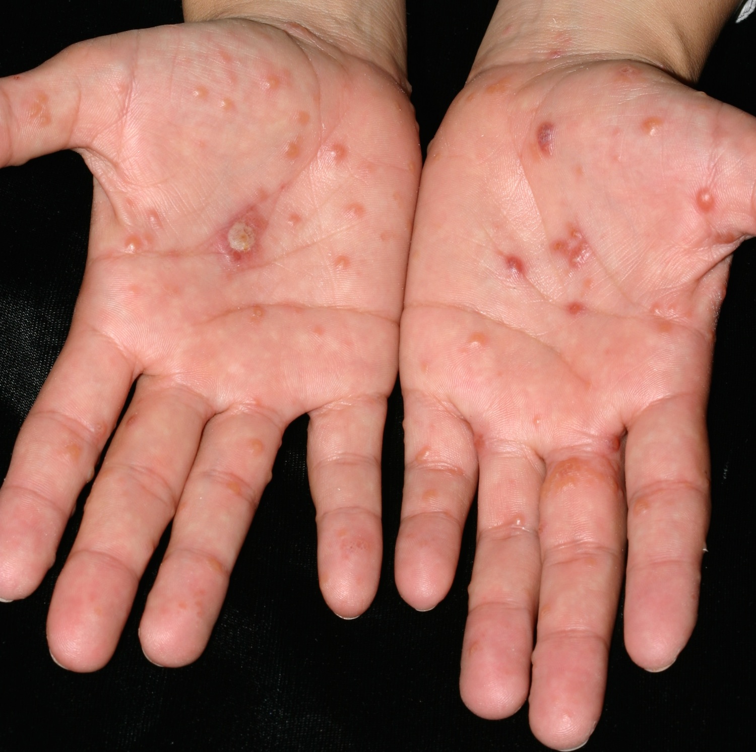 itchy-bumps-on-hands