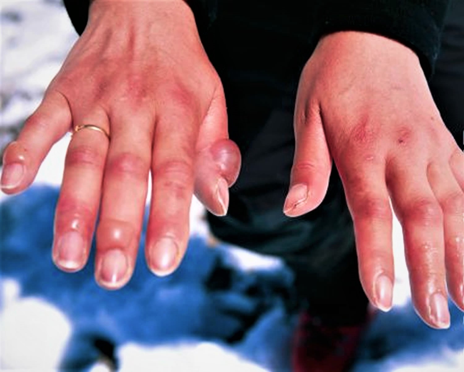 frostbite-causes-prevention-signs-symptoms-frostbite-treatment